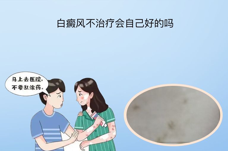 白癜风不治疗会自己好的吗”
