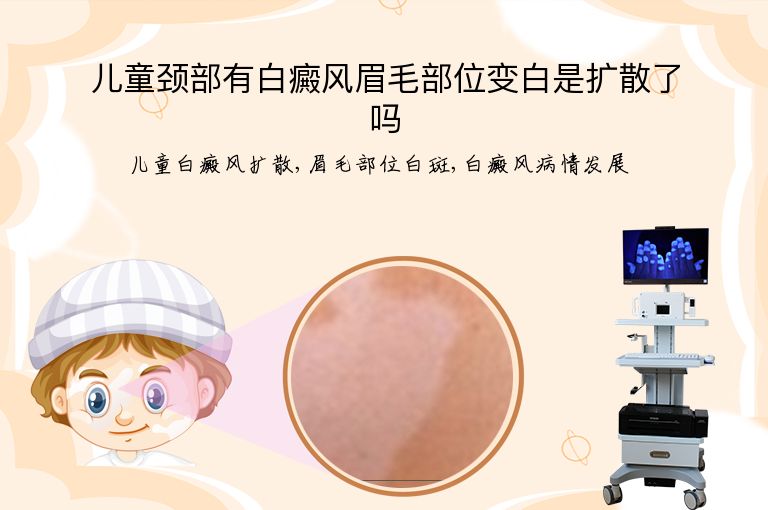 儿童颈部有白癜风眉毛部位变白是扩散了吗”