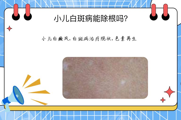 小儿白斑病能除根吗？”