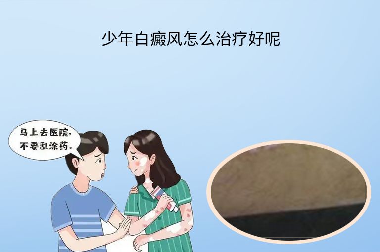 少年白癜风怎么治疗好呢”