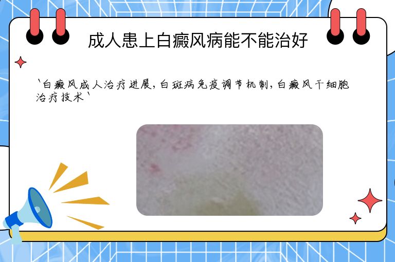 成人患上白癜风病能不能治好”
