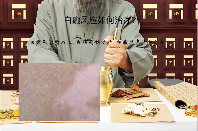 白癜风应如何治疗？”