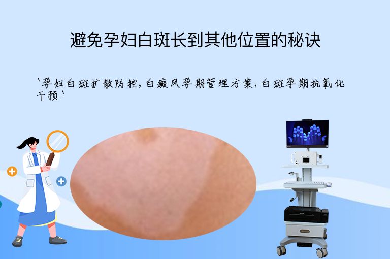 避免孕妇白斑长到其他位置的秘诀