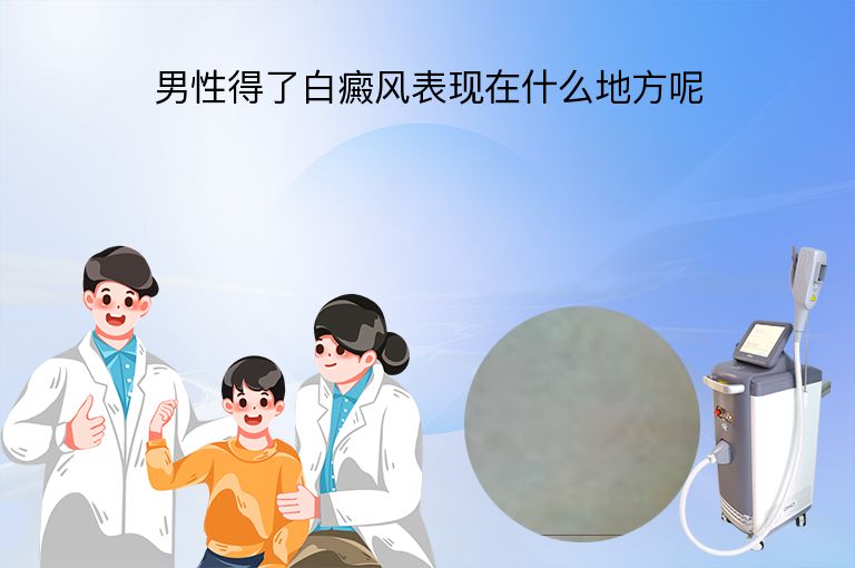 男性得了白癜风表现在什么地方呢