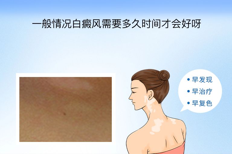一般情况白癜风需要多久时间才会好呀”