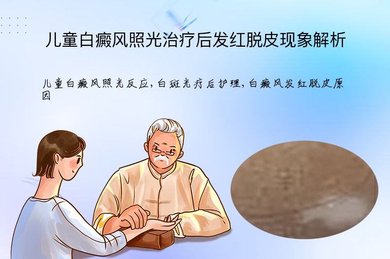 儿童白癜风照光治疗后发红脱皮现象解析”