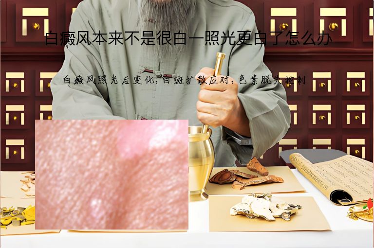 白癜风本来不是很白一照光更白了怎么办”