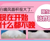 小孩子手上长小白斑需要检查吗
