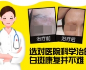 手上长了小白斑需要检查吗