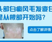 手上白斑是什么怎么回事”