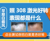 手上有白斑图片要怎么才能祛除