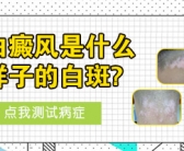 手上长了好多小白斑咋回事