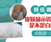 手上白癜风照射308激光一周需要照射几次”