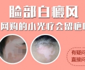 两岁宝宝脸上有白斑是怎么会事这种情况严重吗”