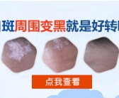 小孩子手上小白斑要怎么才能祛除”