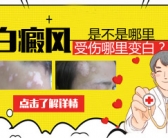 手上皮肤出现白斑是什么原因