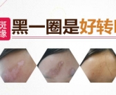 手背长小白斑图片怎么能治好”