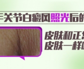 白癜风多久做一次激光”