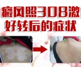 白癜风不是很严重外用什么药好”