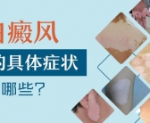 小孩长白斑怎么治疗好的快”