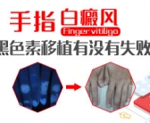 手上出白斑需要用药吗”