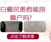 手上皮肤出现白斑怎么能治好”