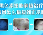 初生手上长小白斑怎么才能去除