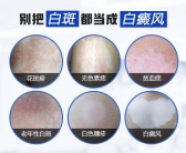 白癜风什么情况下能做黑色素移植”