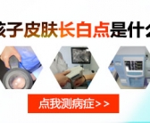 手上一块块的白癜风能种植黑色素吗”