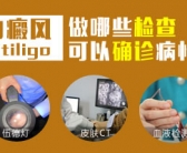 白癜风长在手上怎么治效果很好”