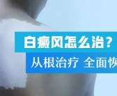 孩子脸上有白斑是什么引起的”