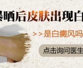 小孩有白癜风照射308激光每周照多少次”