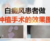 手上的小白斑怎么才能去除”