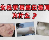 2022年治疗白癜风用什么方法治疗”