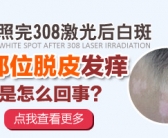手上长白斑怎么办需要用药吗