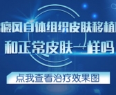 小儿手上长白斑怎么能治好