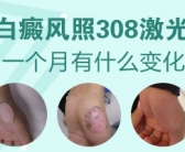 男性白癜风做黑色素治疗哪里好”