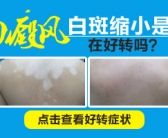 大片白癜风怎么控制能快速康复”