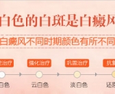 白癜风处于稳定期怎么控制见效快无危害”