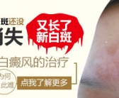 手上皮肤出现白斑该怎么治”