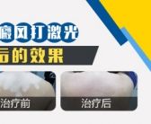 一个激光光斑有多大 照多久能治好白癜风”