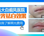 手上皮肤出现白斑要怎么才能祛除”