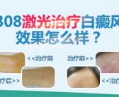 一般白癜风照308激光一周照射多少次”