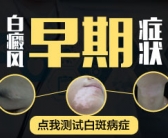 手上得白癜风早期有没有好的药方”