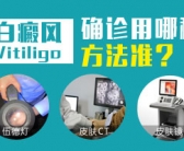 手上有白斑图片需要检查吗