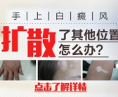 手上起了白斑怎么能治好
