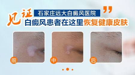 孕期白癜风是否会遗传给宝宝？