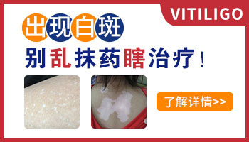 孩子成长阶段白癜风治疗指南:科学应对,健康成长