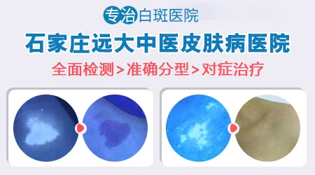 如何有效检测儿童白癜风病情?