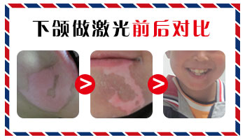 孩子脸上的白斑,是白癜风的信号吗?